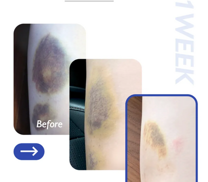 GENABELLE Laser Vita K Resue Gel